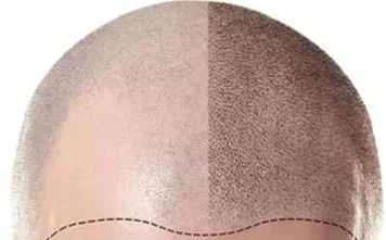کاشت مو