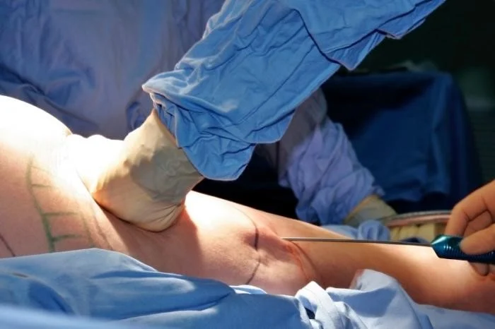 Complications of lipomatic surgery