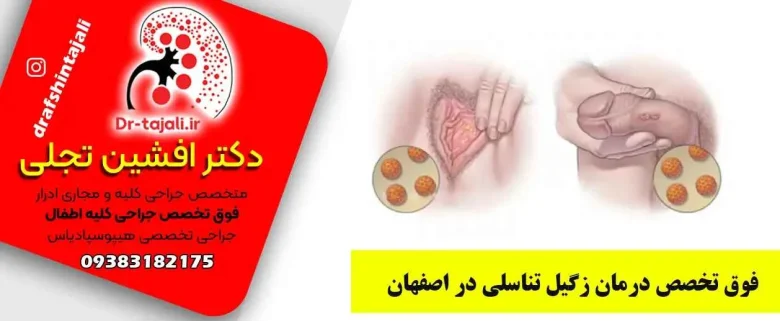 درمان زگیل تناسلی